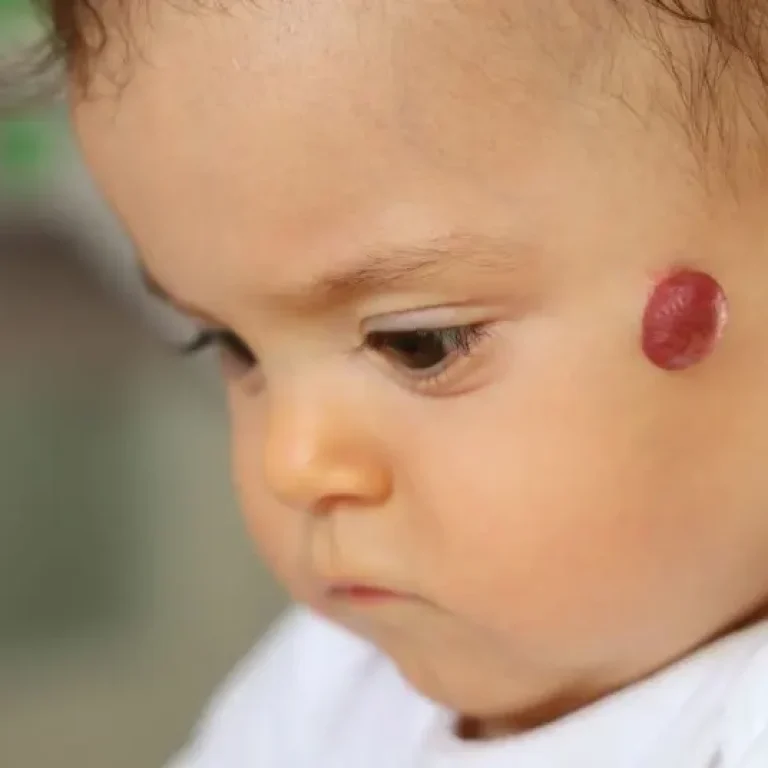 Αιμαγγείωμα