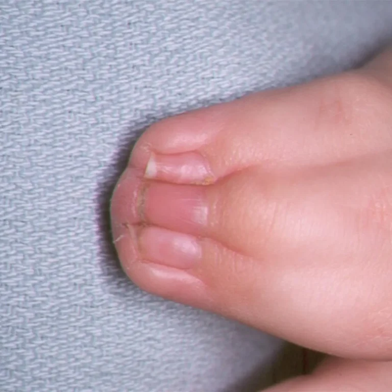 Συνδακτυλία (1)